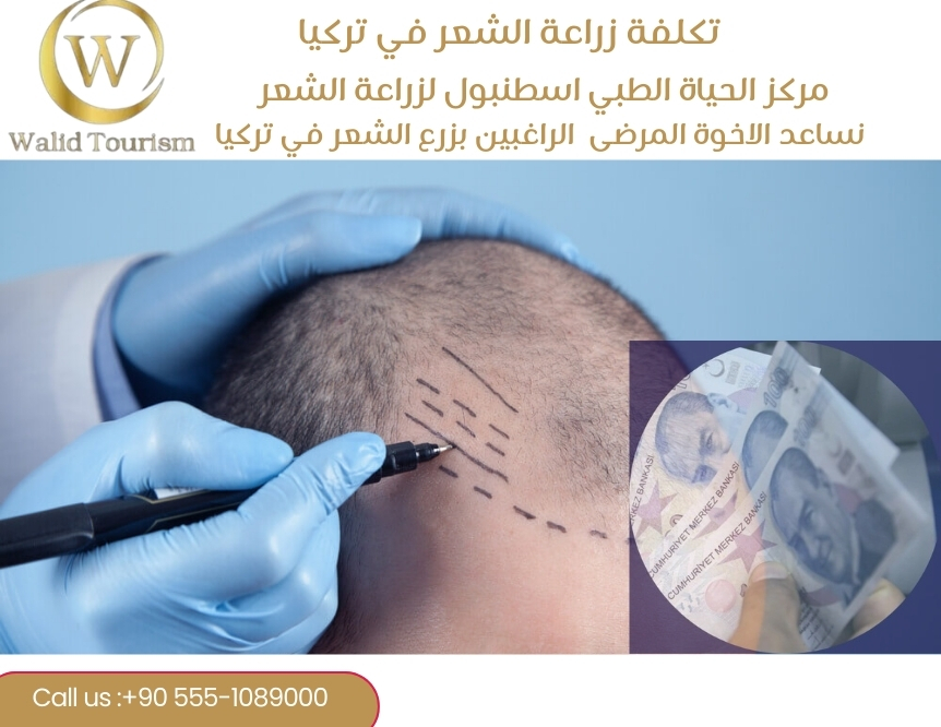 تكلفة زراعة الشعر في تركيا 2025